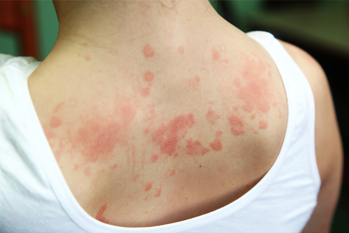 What To Do When You Have an Allergic Reaction