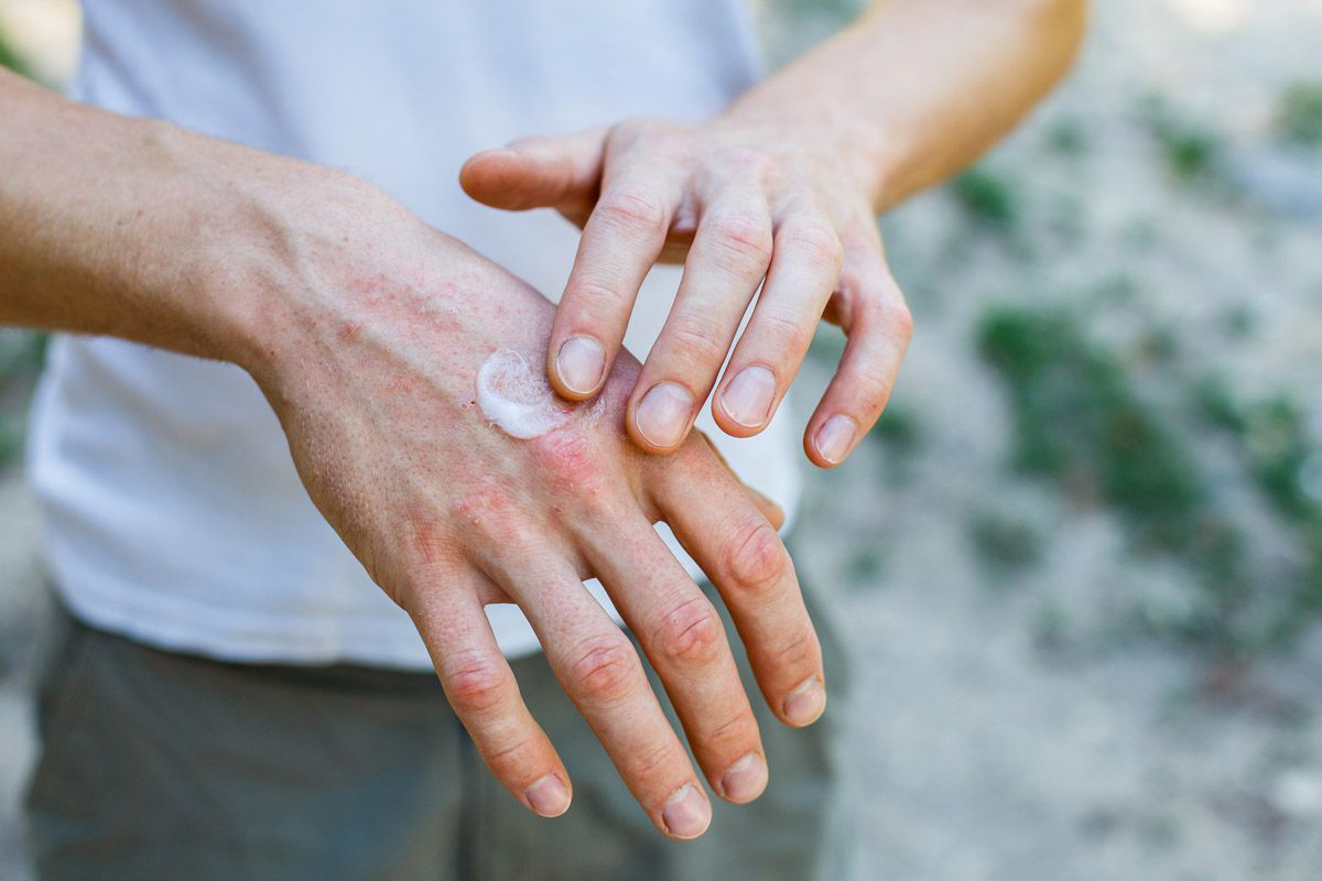 How Can You Tell if a Rash is Serious?